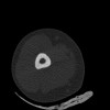 SPORK, NICO - 22.03.1976 - 02.08.2022 - CT obere Extremität - 17:51:17